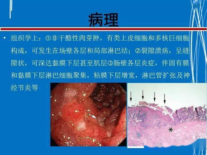 克罗恩病完整诊断 克罗恩病：情绪过山车与终身挑战，你了解多少？