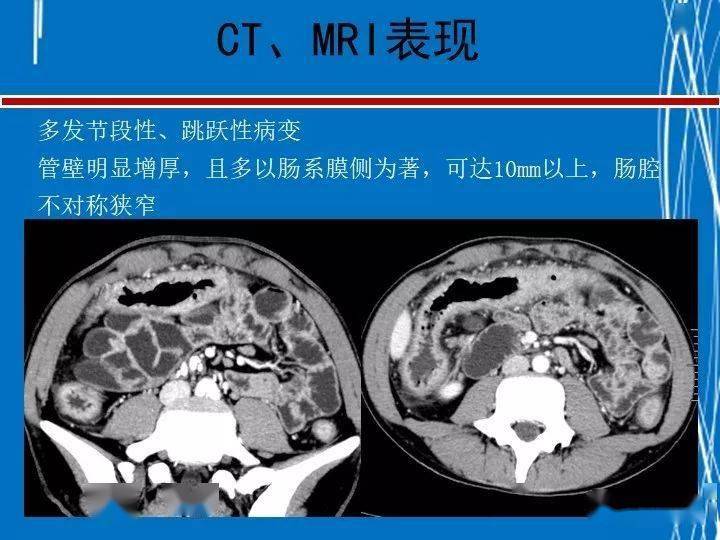 克罗恩病诊断书写_克罗恩病理诊断_克罗恩病完整诊断