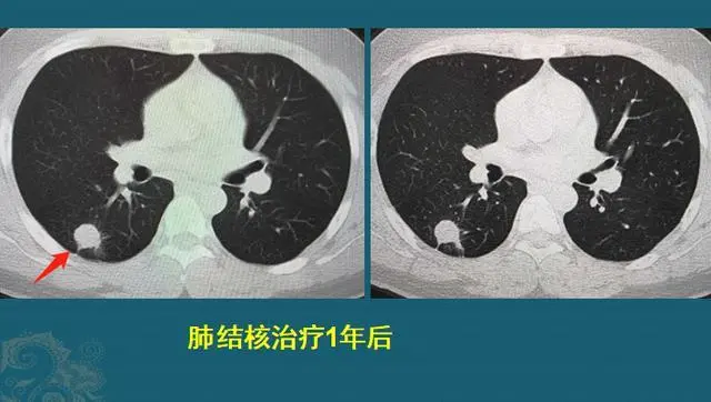 肺结核严重以后是什么_肺结核严重后的症状_肺结核最严重的后果
