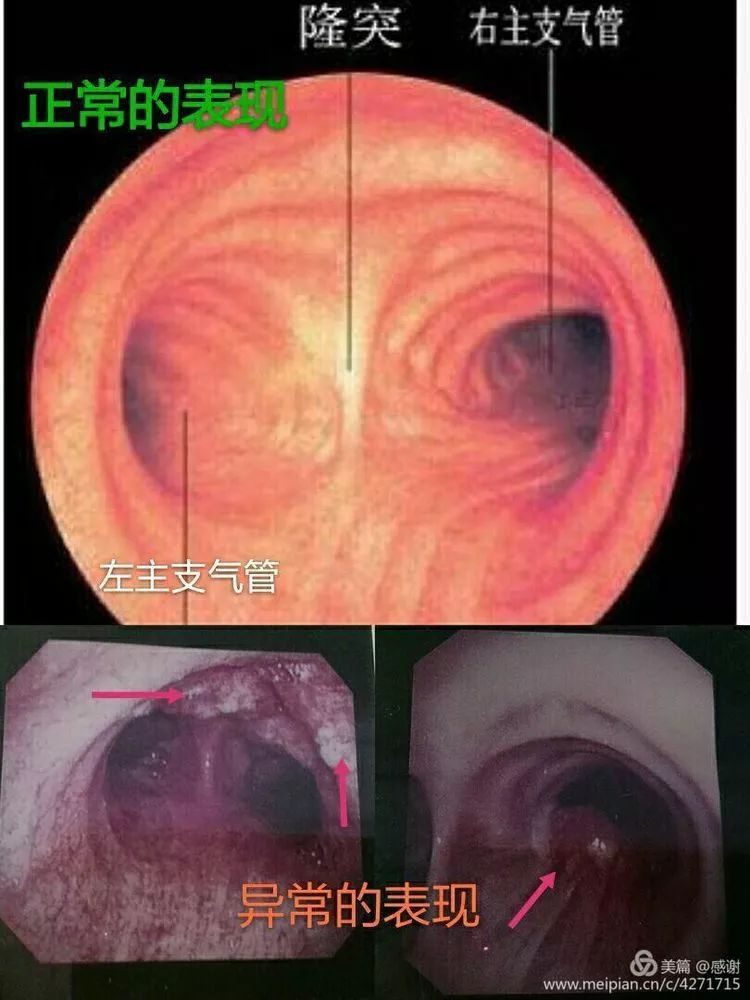 哮喘患者视频_哮喘犯病视频_哮喘发作的短视频