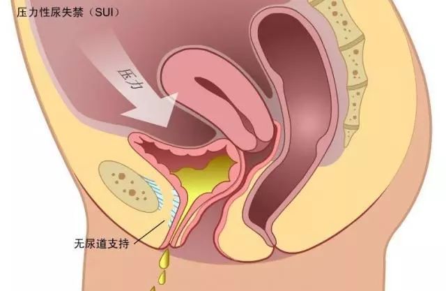 肛门脱垂严重的会怎样_肛门垂脱需要手术吗_肛肠脱垂肛门失禁