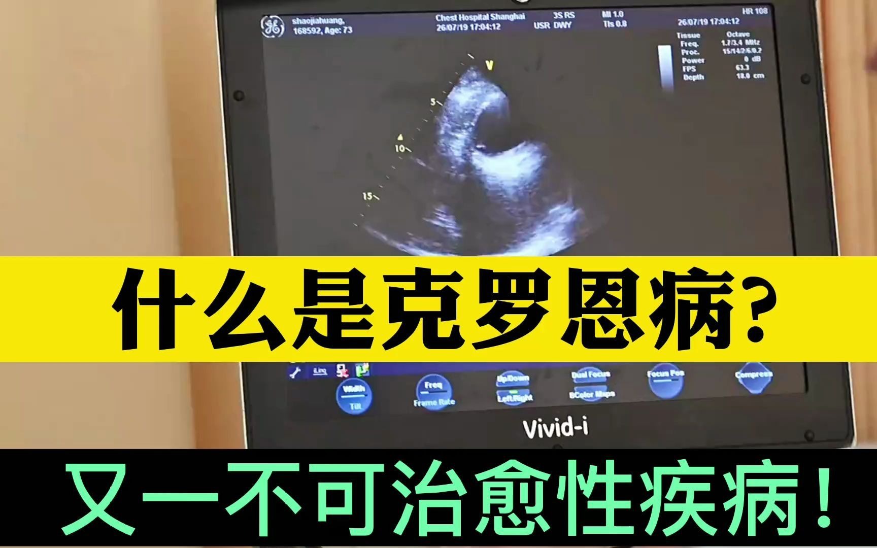 克罗恩膝关节痛_克罗恩导致的关节炎的症状_克罗恩可以引起关节炎